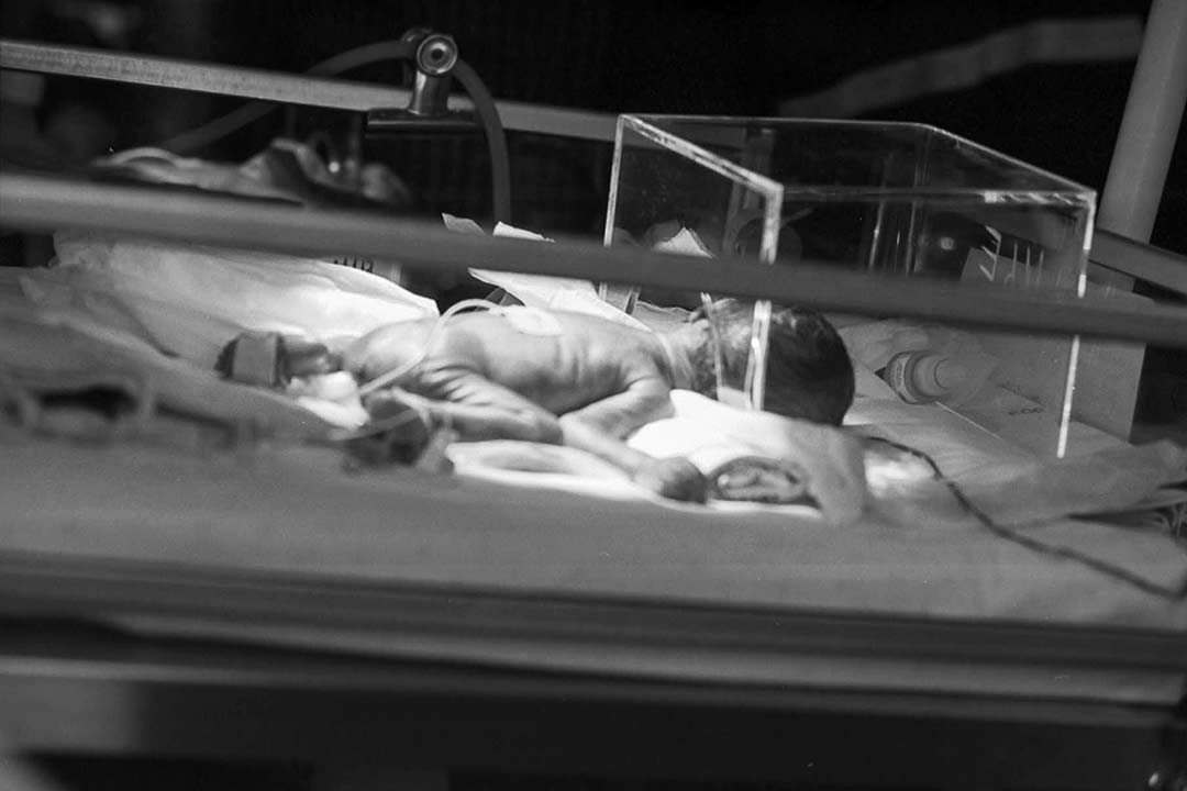 black and white image of a very small premature baby lying in an incubator